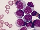 Leucemia mieloide aguda