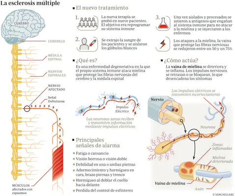 Prueban Con Exito Una Terapia Esperanzadora Contra La Esclerosis Multiple