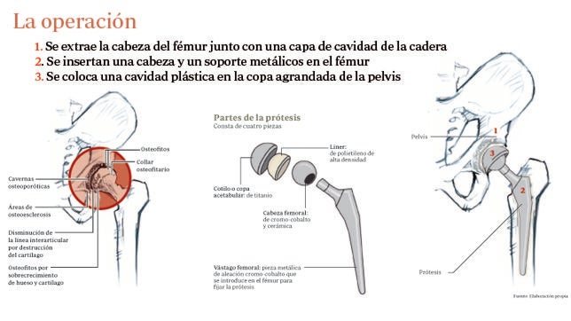 Las claves de la operación por la que se sustituirá la prótesis de la cadera del Rey