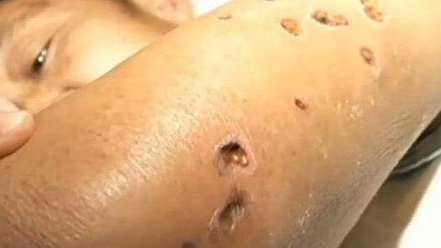 Así son las picaduras de avispa que han dejado 42 muertos en China