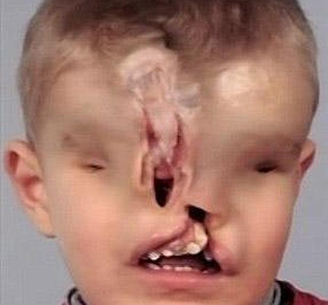 sangrado nariz y boca en niños
