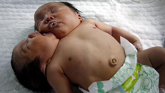 Un bebé con dos cabezas en China