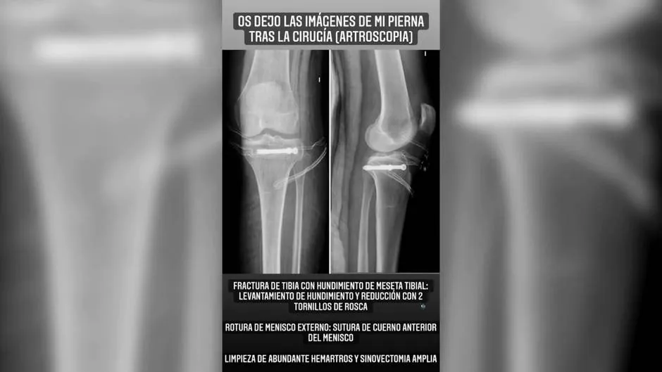 Carla Barber Comparte Imagenes De Su Operacion Tras Fracturarse La Tibia