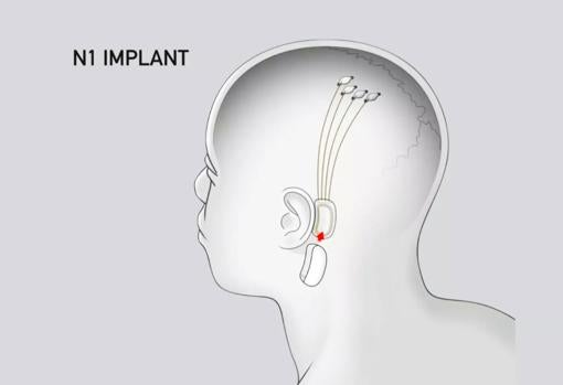 Diagram of how the "threads" would be implanted