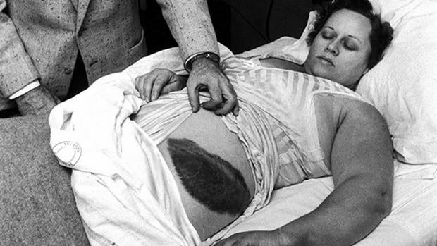 Imagen de Ann Hodges donde se aprecia el moratón provocado por el meteorito