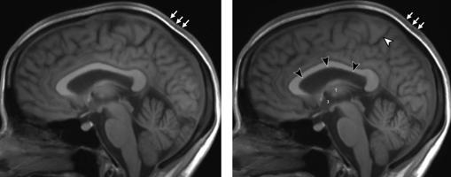 Cerebro de un astronauta antes (izquierda) y después del vuelo (derecha)