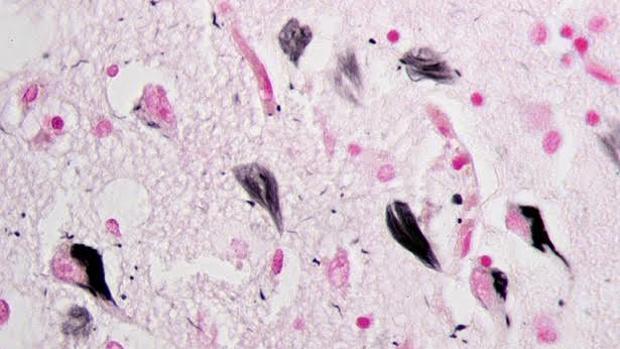 Ovillos neurofibriilares de proteína tau en el hipocampo de un paciente con alzhéimer