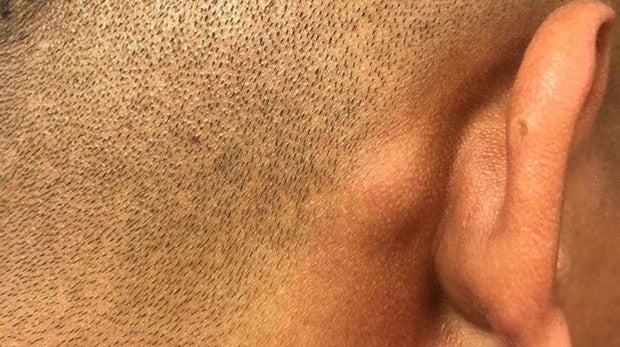 Golpe que recibió una de las víctimas detrás de la oreja