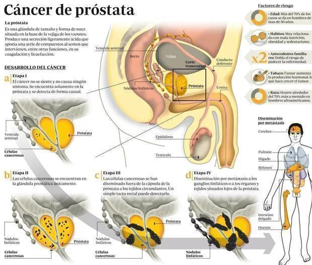 Cancerul de Prostata