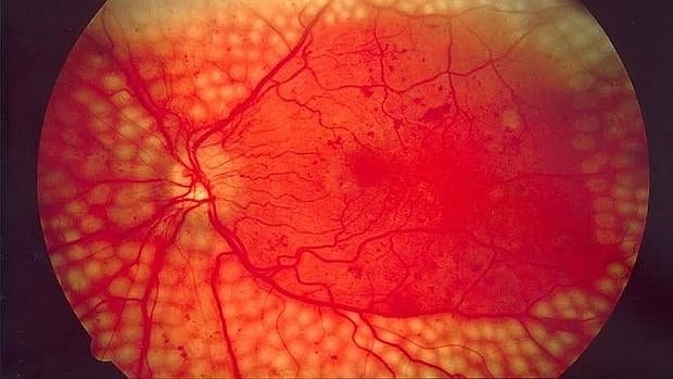 Retinopatía diabética