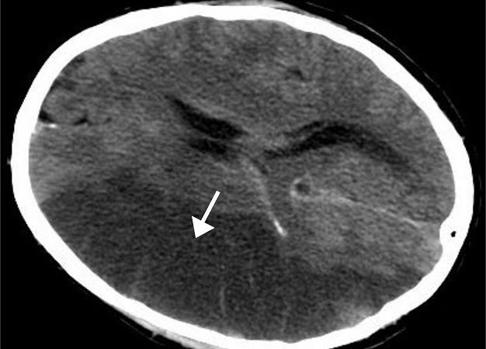 El riesgo asociado a la fibrilación auricular va más allá del ictus