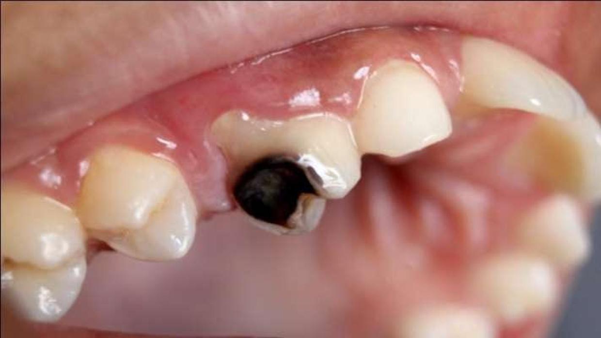 No hay excusas: las caries son consecuencia de la higiene y