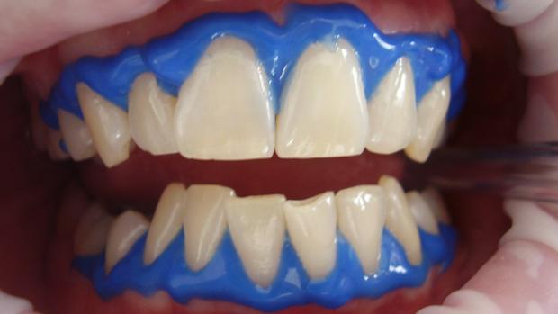 Caseras los postizos para dientes blanquear recetas