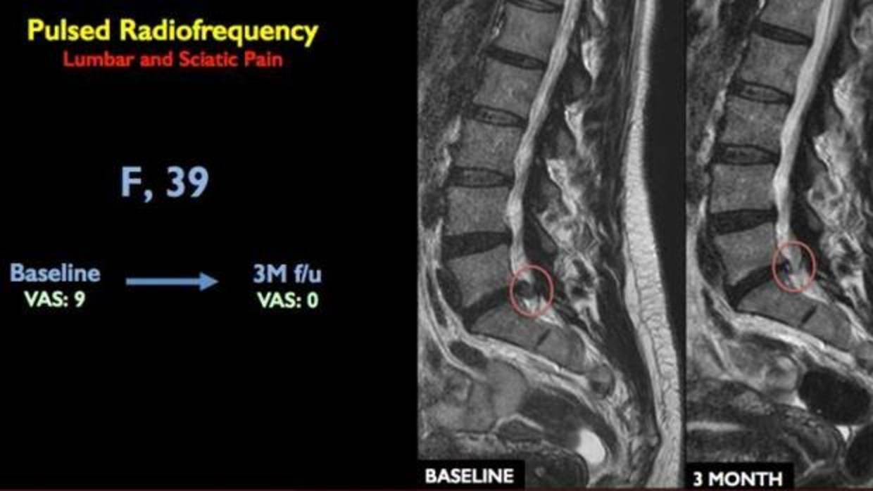 hernia+discal+l5+s1+sintomas+tratamiento