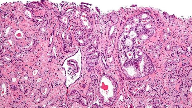 últimos descubrimientos sobre el cáncer de próstata
