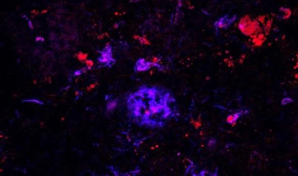 Unión de anticuerpos frente a ApoE (en rojo) a las placas de beta-amiloide (en azul) en el tejido cerebral de un paciente con alzhéimer