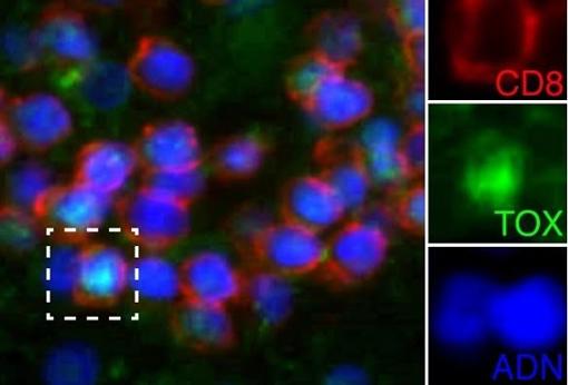 Expresión de TOX (en verde) en linfocitos T CD8+ (en rojo) en la esclerosis múltiple