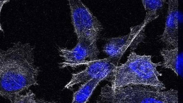 tratamiento para el cáncer de próstata que se ha diseminado al hígado