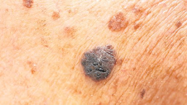 Lunar sospechoso de ser melanoma