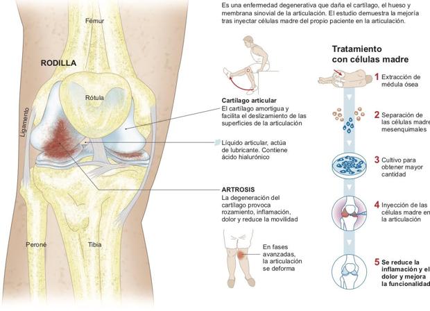 Inflamacion del hueso de la rodilla