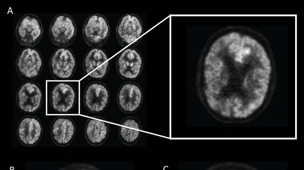 Neuronas afectadas por la enfermedad del alzheimer