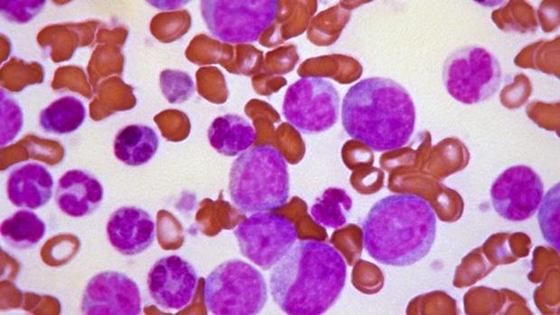 Células de leucemia