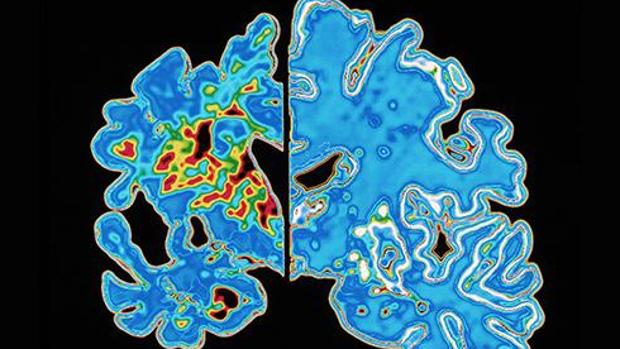 Cerebro con enfermedad de Alzheimer