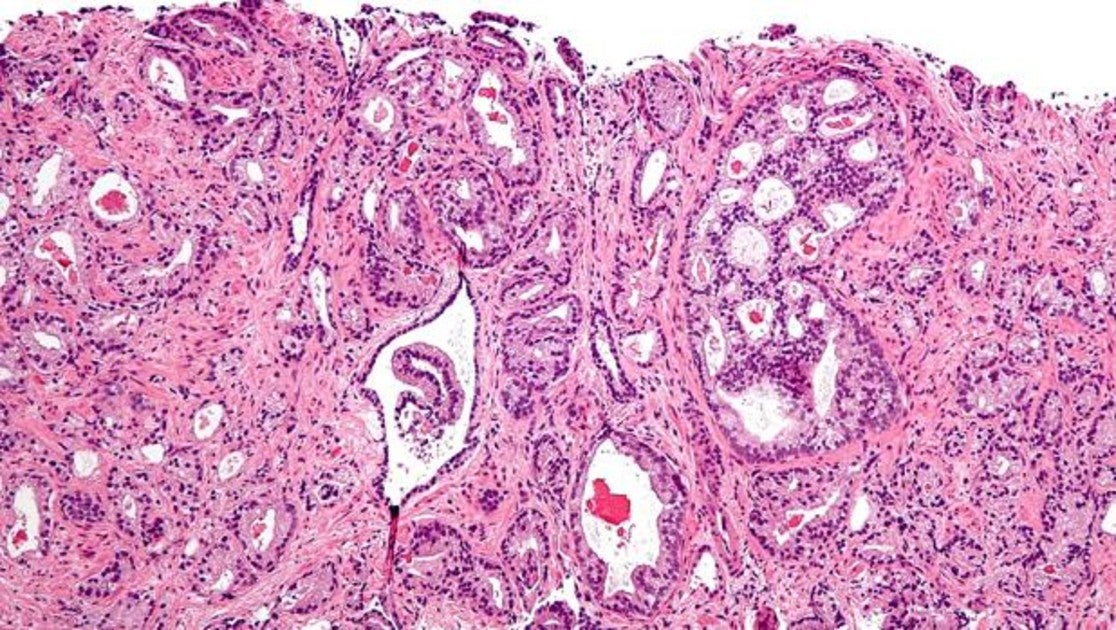adenocarcinoma de próstata grado 7 de gleason 5