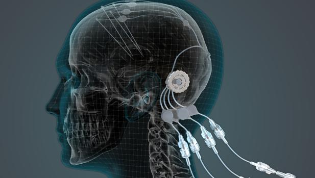 Estimulación profunda con electrodos