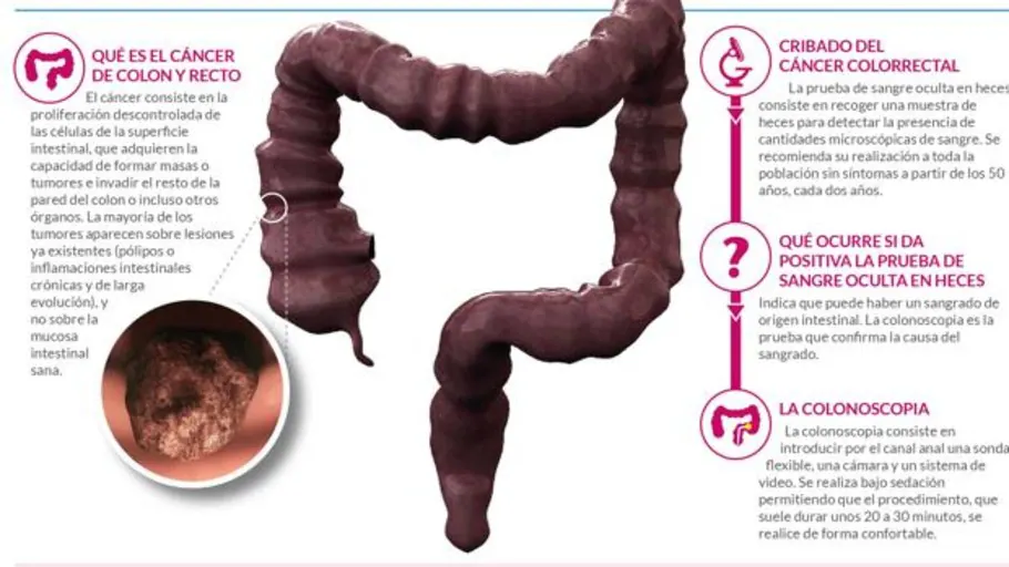 cancer de colon en mujeres jovenes sintomas