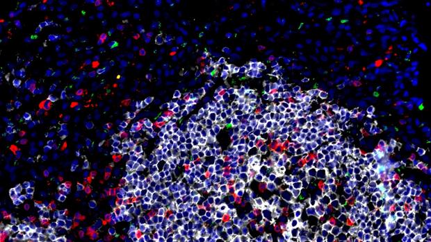 Células linfáticas innatas (verdes) cerca y dentro de un área pequeña de inflamación en un primate no humano infectado con Mycobacterium tuberculosis, la bacteria que causa la TB.
