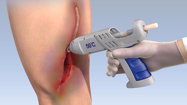 Adios A Los Molestos Puntos Y Grapas Con Esta Pistola De Pegamento Para Cerrar Heridas