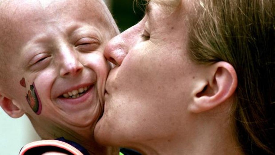 Investigadores españoles hallan una terapia que mejora la esperanza de vida en progeria