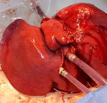 Hígado conservado