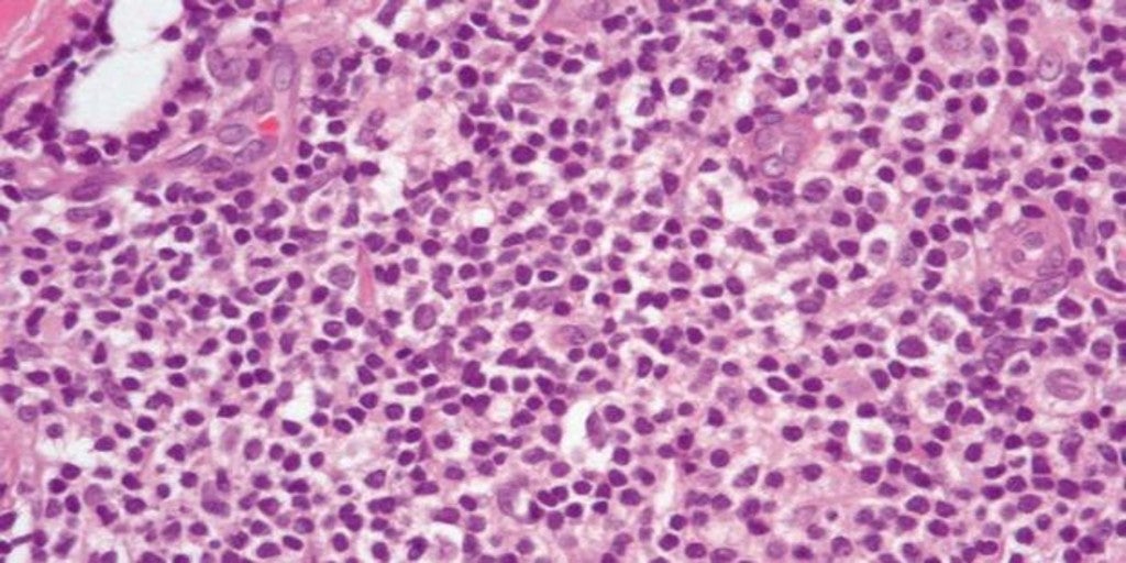 Las células B mejoran los resultados de la inmunoterapia en cáncer