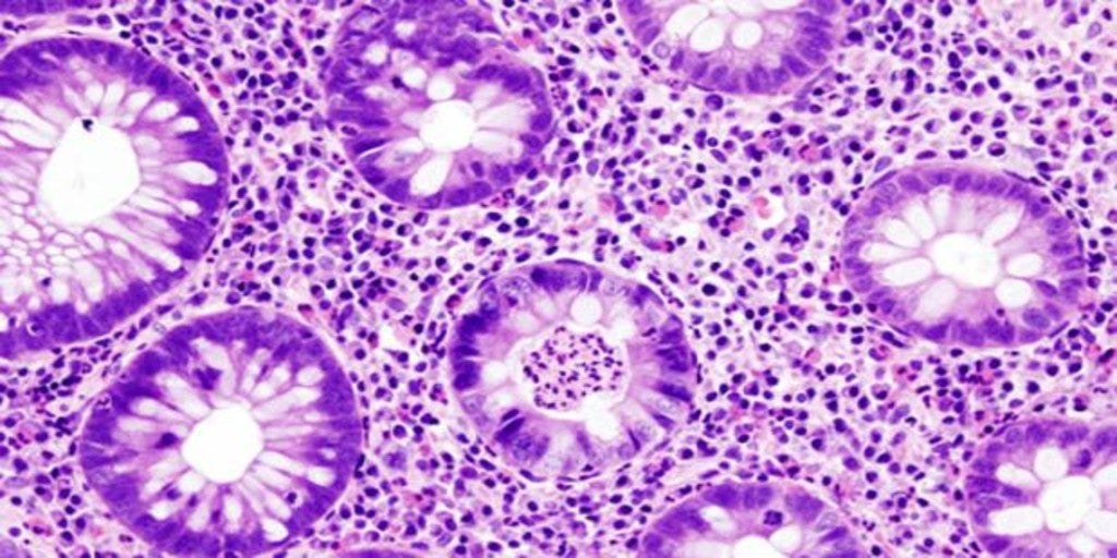 Ulcerative colitis is associated with the absence of intestinal