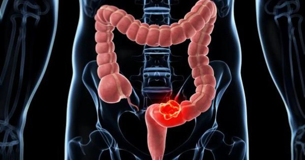 cancer de colon en mujeres sintomas)