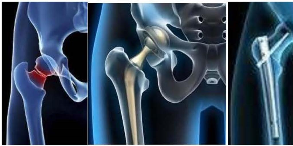 Why early surgery is so important in patients with hip fractures