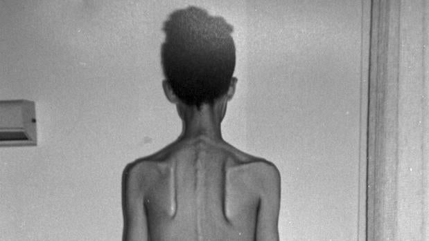 bulimia y cuales male offspring sus causas