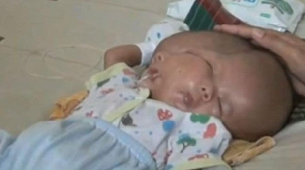 Un Bebe Nace Con Dos Caras Y Dos Cerebros Despues De Que Su Gemelo No Se Desarrollara