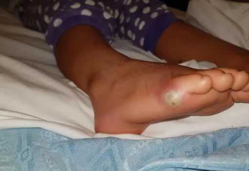 Una Nina Al Borde La Muerte Al Contraer Sepsis Por Probarse Zapatos Con Los Pies Descalzos